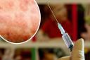 Measles is on the rise across the country