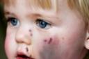 One-year-old Paige Foster with the facial injuries she suffered after a dog attacked her