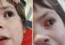 Injury to Yahiya Berzeviczny's eye at nursery, pictured above