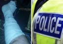Police are investigating after Abid Beecroft said he suffered a ruptured Achilles tendon when he was 'run over' in Bradford