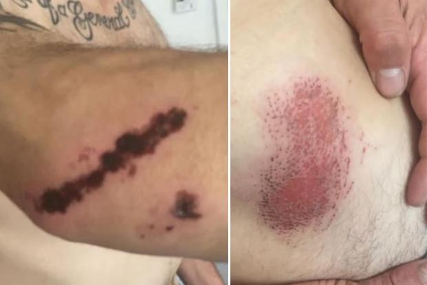 Bradford Telegraph and Argus: An injury on Peter Kane's arm and graze on his thigh