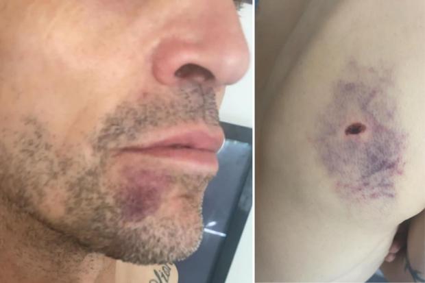 Bradford Telegraph and Argus: A bruise on Peter Kane's chin and one on his back