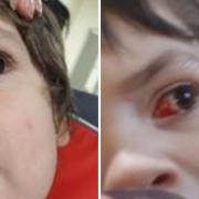 Injury to Yahiya Berzeviczny's eye at nursery, pictured above