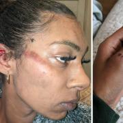 Shasa Cummings was left with bruises, scratches and a black eye following the assault