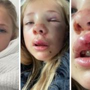 Erinne Birkhead, 7, suffered multiple facial injuries after being hit by an e-scooter.