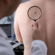 Skin cancer has affected people all over the world including the likes of Duchess of York - Sarah Ferguson, Australian actor Hugh Jackman and radio DJ Chris Evans.