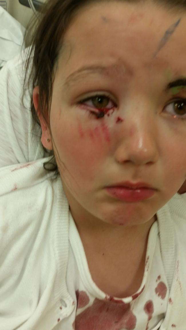Five-year-old Nieve, from Clayton, was attacked by a Staffordshire bull terrier-type dog in Hebden Bridge